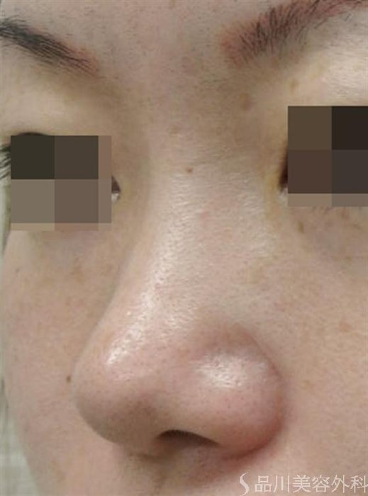 症例NO.16432のBEFORE写真