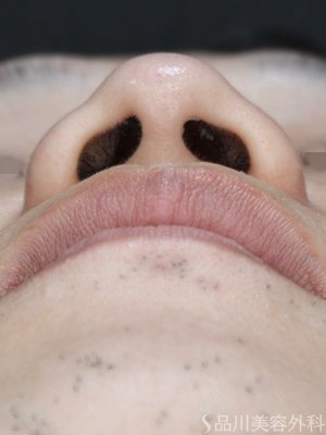 症例NO.75045のBEFORE写真