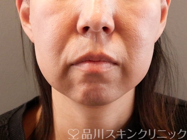 症例NO.62851のAFTER写真