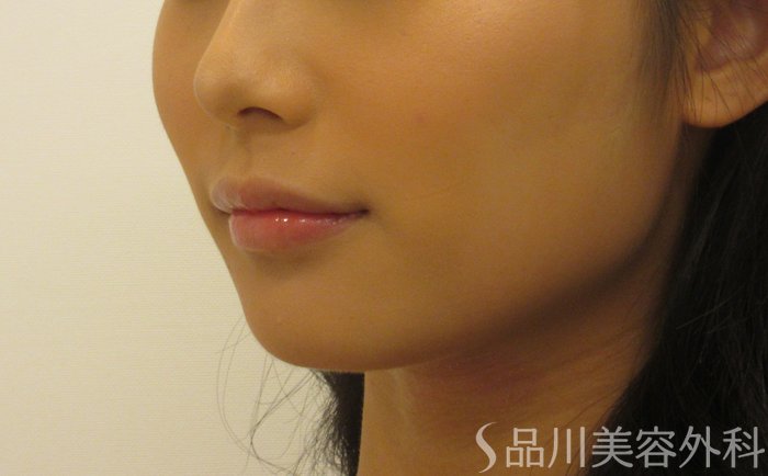 症例NO.71689のBEFORE写真