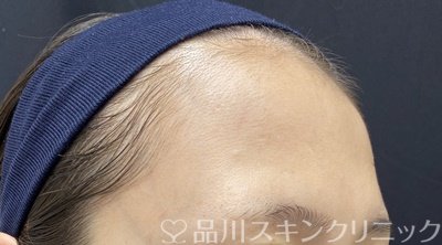 症例NO.63833のBEFORE写真