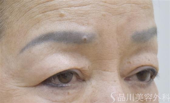 症例NO.54369のBEFORE写真
