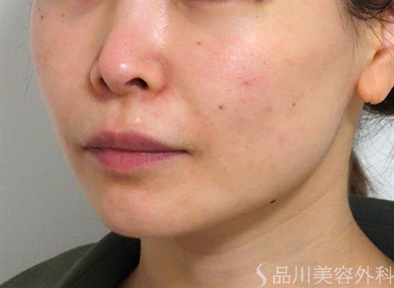 症例NO.35709のBEFORE写真