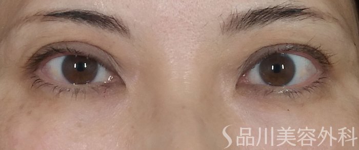 症例NO.73078のAFTER写真