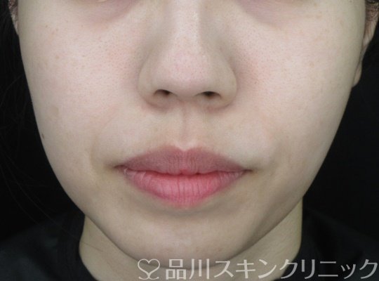症例NO.68734のAFTER写真