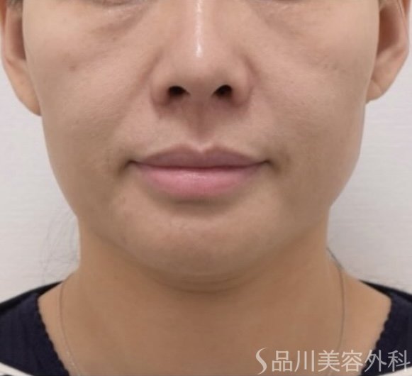 症例NO.71647のBEFORE写真