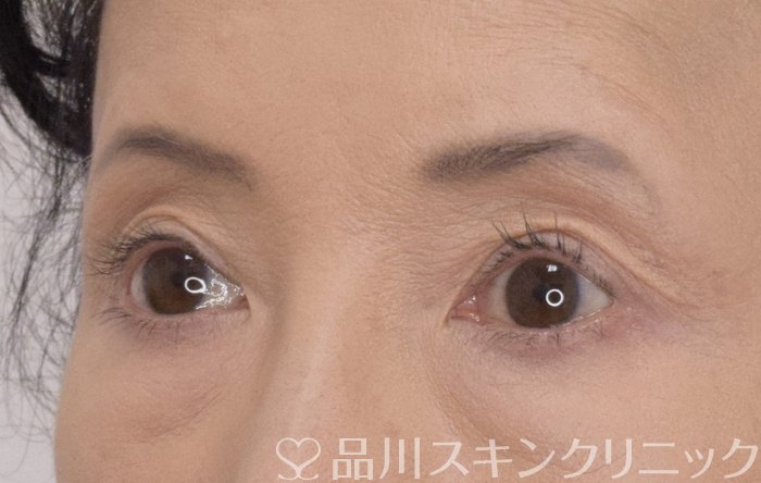 症例NO.69556のAFTER写真