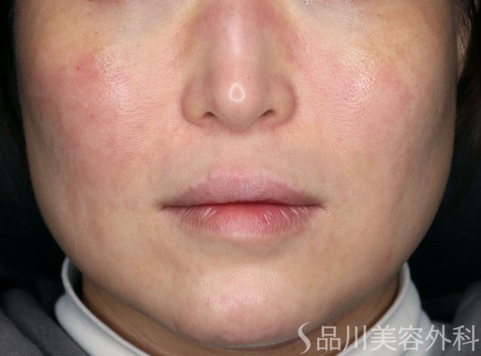 症例NO.73451のBEFORE写真