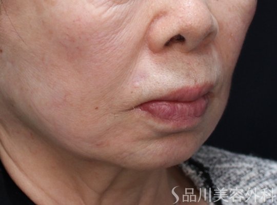 症例NO.73761のAFTER写真