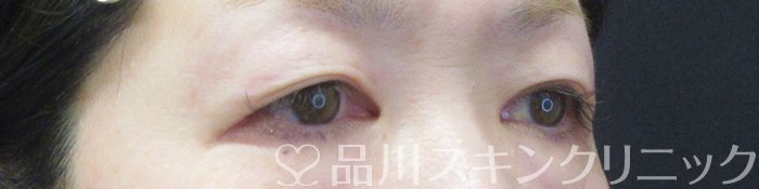 症例NO.67850のBEFORE写真