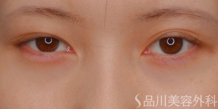 症例NO.73529のAFTER写真