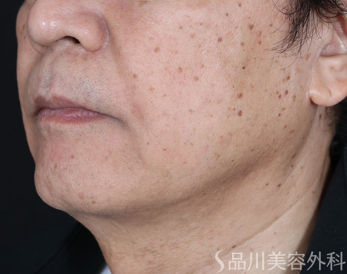症例NO.71853のBEFORE写真