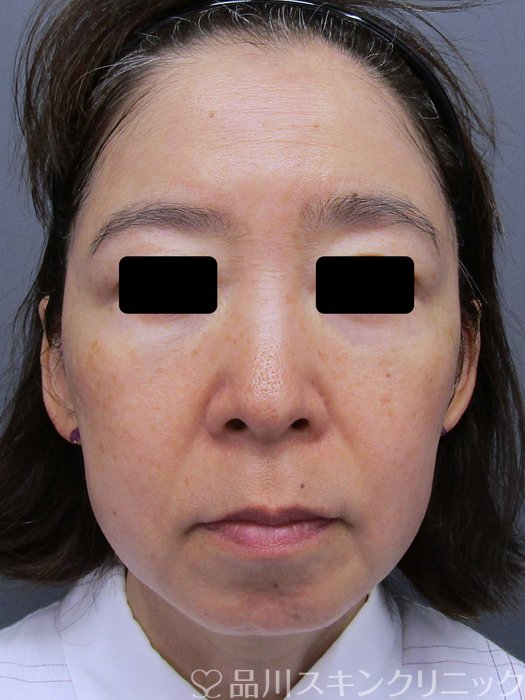 症例NO.74848のBEFORE写真