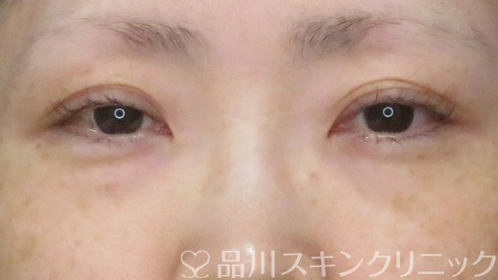 症例NO.68999のBEFORE写真