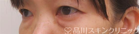 症例NO.55663のBEFORE写真