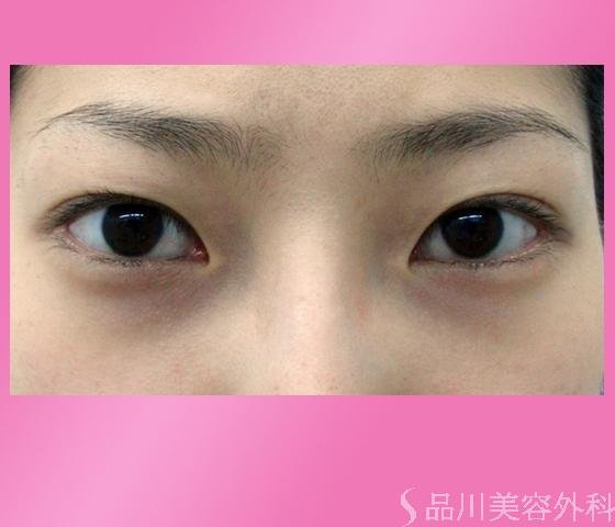 症例NO.1243のBEFORE写真