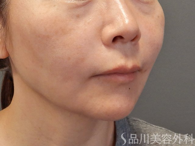 症例NO.74471のBEFORE写真