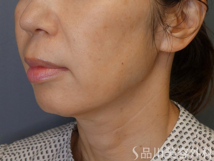 症例NO.71534のBEFORE写真
