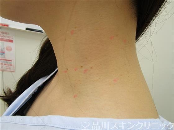 症例NO.39241のBEFORE写真