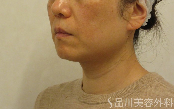 症例NO.72089のBEFORE写真