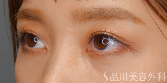 症例NO.73568のAFTER写真