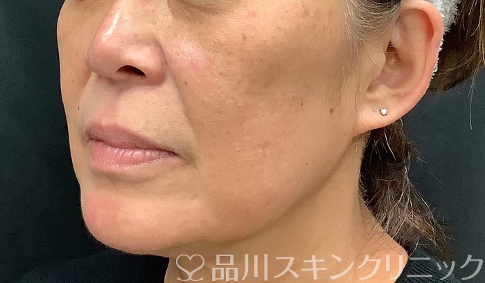 症例NO.67887のBEFORE写真