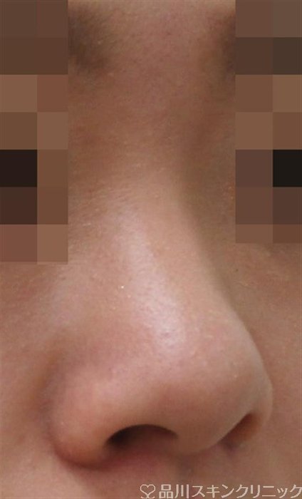 症例NO.42154のBEFORE写真