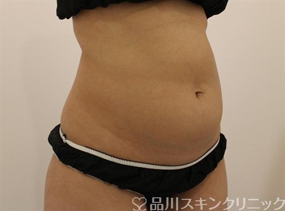 症例NO.46888のBEFORE写真