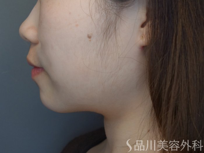 症例NO.73909のAFTER写真
