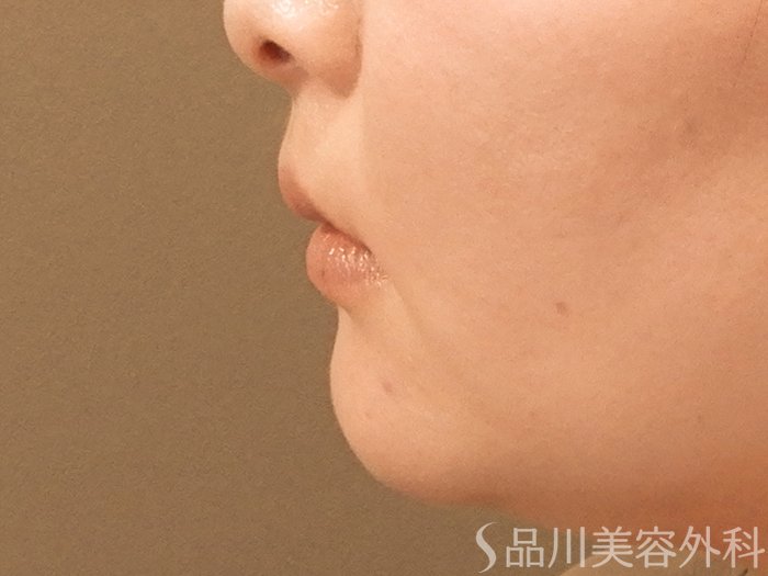 症例NO.69872のBEFORE写真