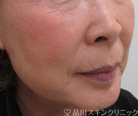 症例NO.33061のBEFORE写真
