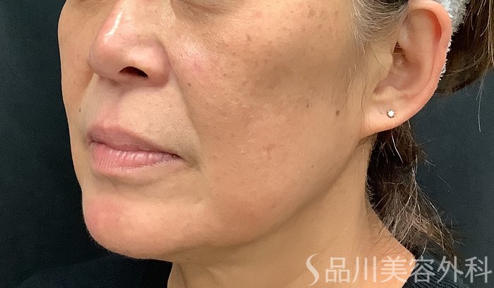 症例NO.67887のBEFORE写真