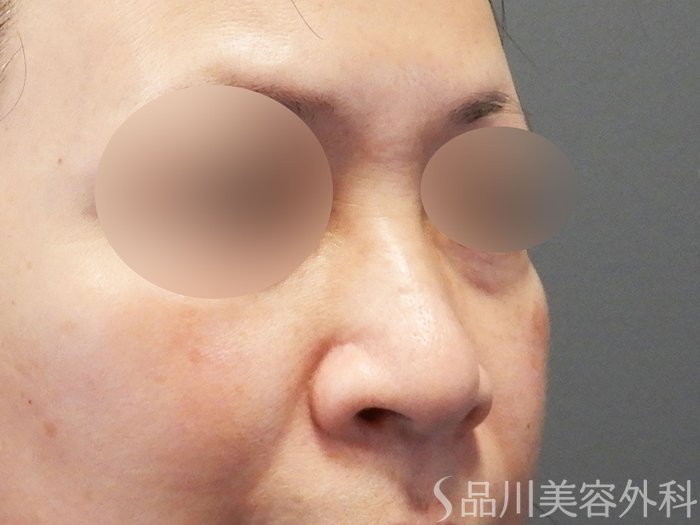 症例NO.70618のBEFORE写真