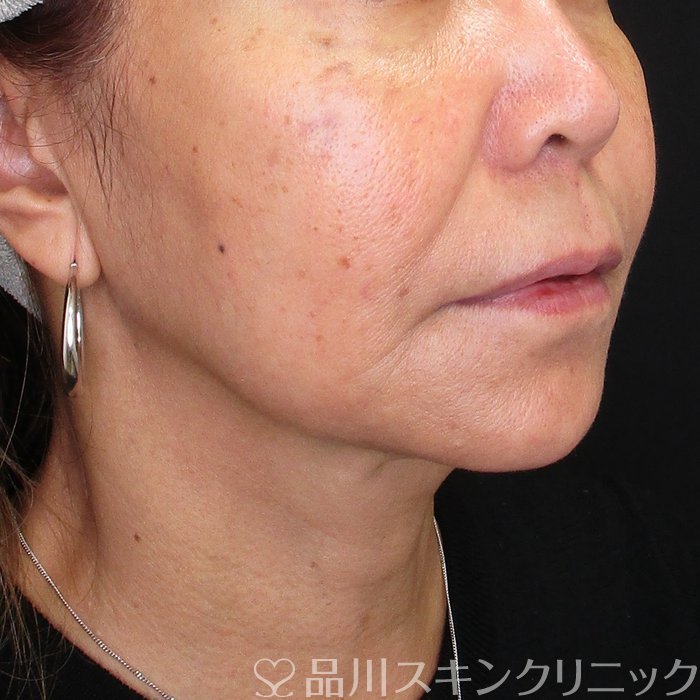 症例NO.74580のBEFORE写真