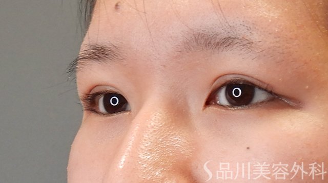 症例NO.75314のAFTER写真