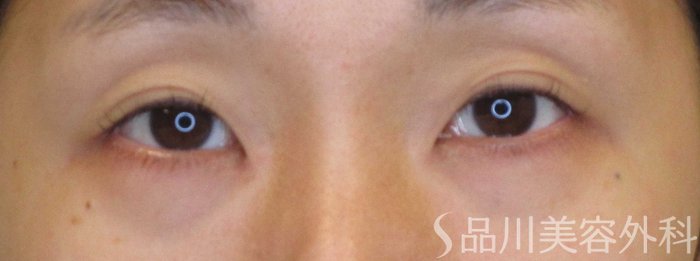 症例NO.70910のBEFORE写真