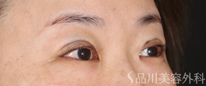 症例NO.72300のAFTER写真