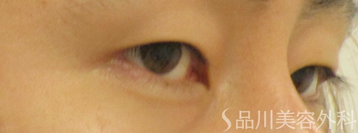 症例NO.65528のBEFORE写真