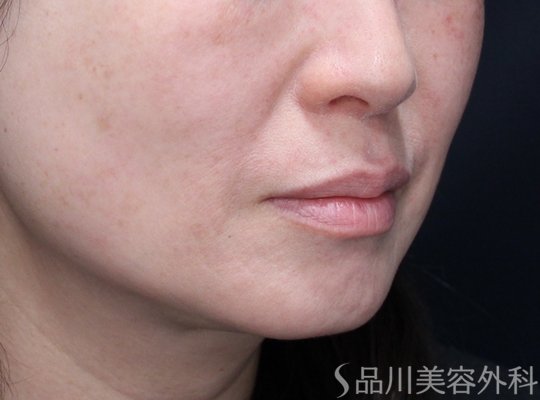 症例NO.73034のBEFORE写真