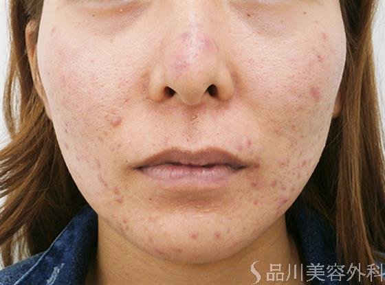 症例NO.25305のBEFORE写真