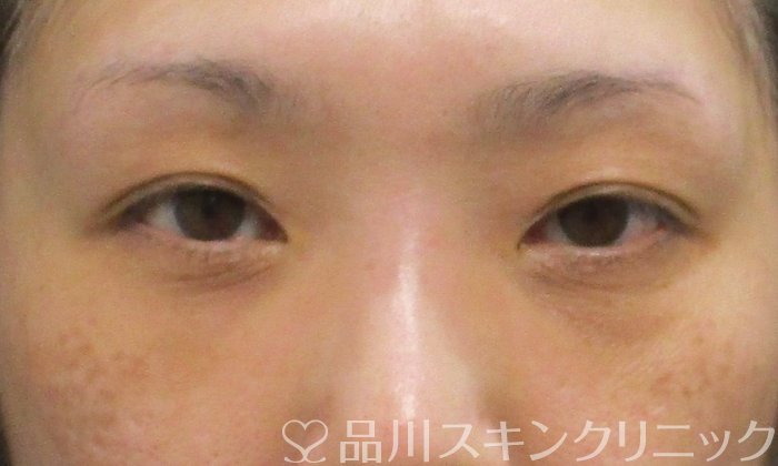 症例NO.71844のAFTER写真