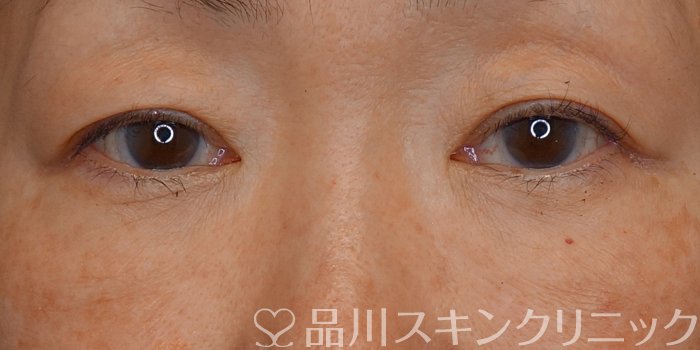 症例NO.72559のBEFORE写真