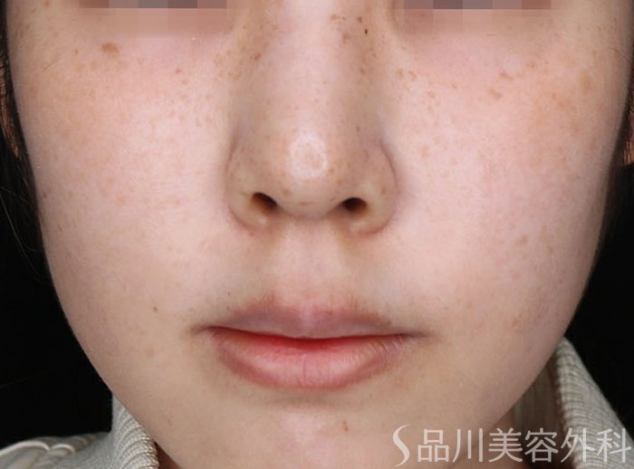 症例NO.72834のAFTER写真