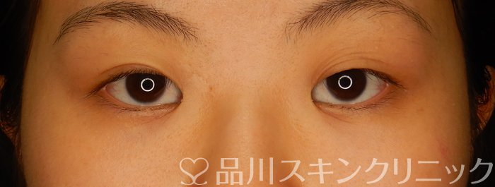症例NO.62414のBEFORE写真