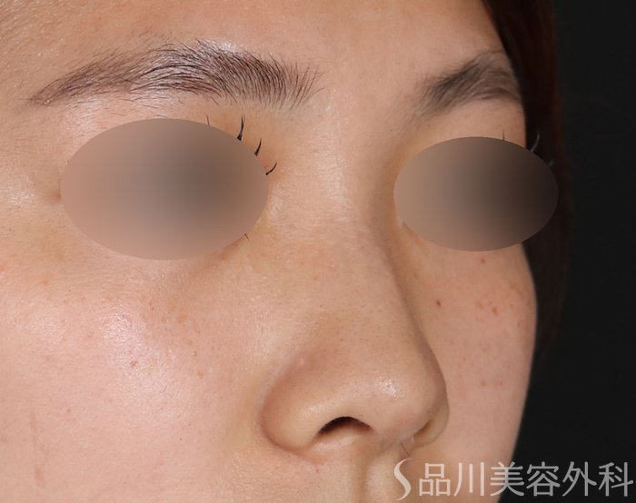 症例NO.71344のBEFORE写真