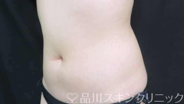 症例NO.70867のAFTER写真