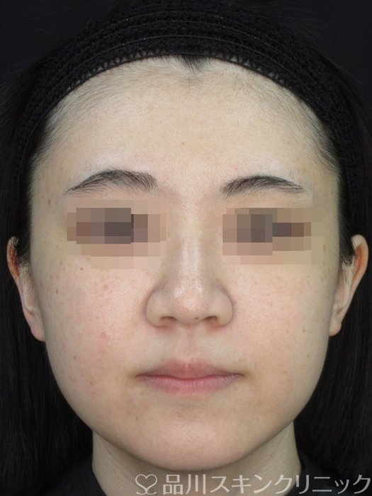 症例NO.73601のAFTER写真