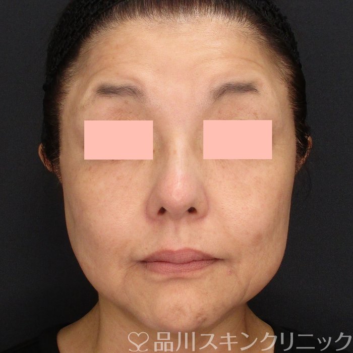 症例NO.73135のBEFORE写真
