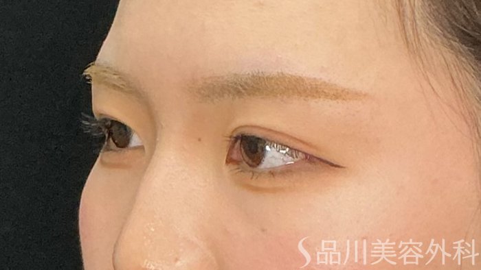 症例NO.72141のAFTER写真