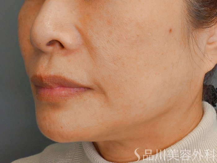 症例NO.73431のBEFORE写真